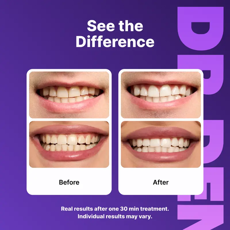 Teeth Whitening Strips – Peroxide-Free 30-Minute Whitening Kit, 14 Strips, Vegan Easy Peel-Off Formula